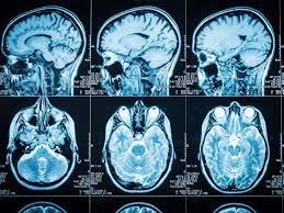 A series of brain scans